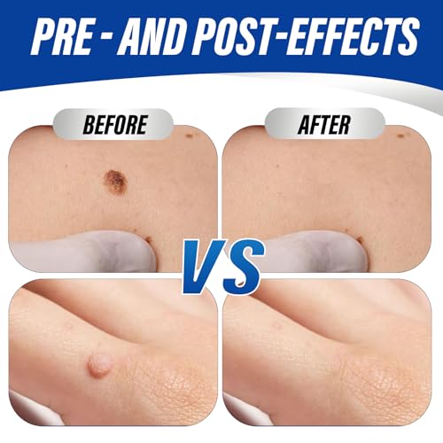 OSNOIA Extra Strength Wart Remover Liquid with 17% Salicylic Acid, Fast Acting Treatment for Plantar & Common Warts, Corn Remover for Feet and Toes 15ml - Thumbnail 5