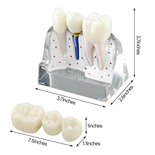 Ultrassist Dental Implant Model For Patient Education, 4 Times Dental Implant, Crown And Bridge Model For Presentation-Transparent #TOP5