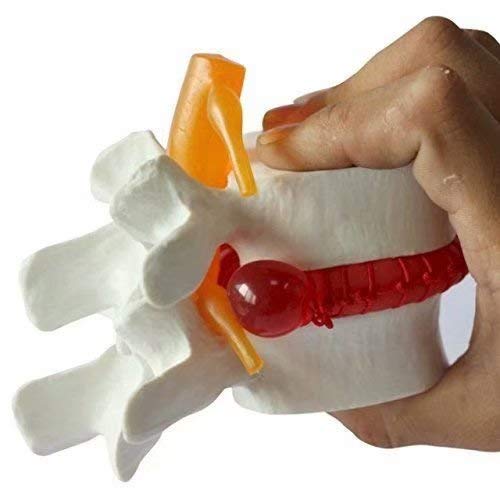 Miniatura 3 de Modelo de demostración de hernia de disco lumbar humana Modelo anatómico de la columna vertebral humana Amarillo