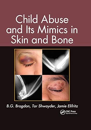 Child Abuse and its Mimics in Skin and Bone Child Abuse and its Mimics in Skin and Bone book cover