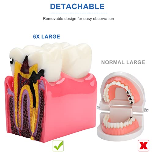Healthible Dental Caries Tooth Model - 6 Times Tooth Decay Model Dental Models For Patient Education Root Canal Model Tooth Model For Teaching Kids #TOP2