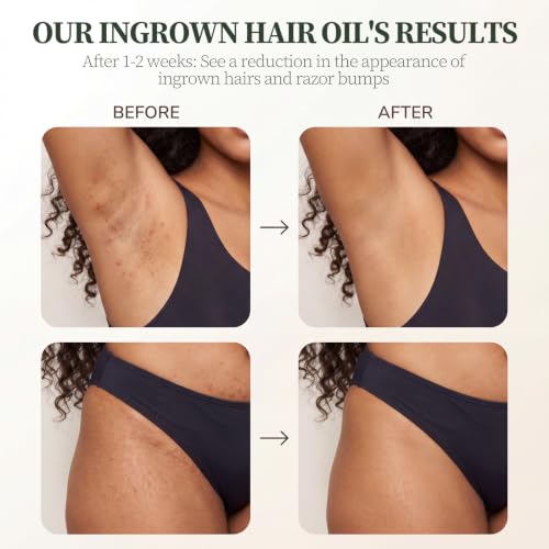 Ingrown Hair Treatment Oil for Women & Men, Soothes Razor Bumps, Prevents Ingrowns, Reduces Redness & Irritation for Bikini Line, Underarms, Legs – Tea Tree, Jojoba & Sage 1oz(30ml) — view 5