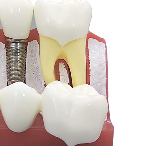 Modèle d'implant dentaire 4x avec couronne amovible pour démonstration - 5