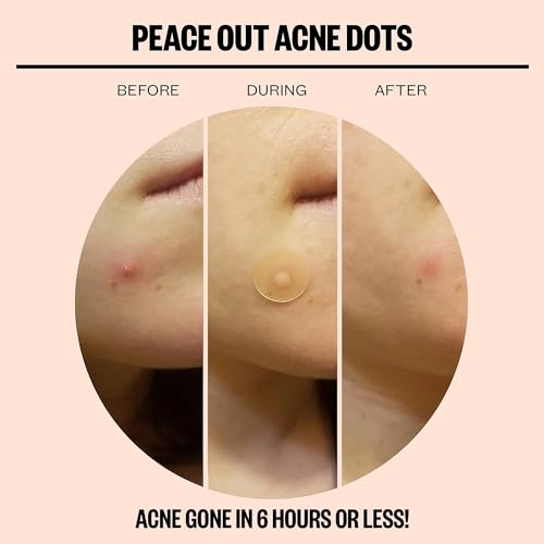 Peace Out Skincare Clear Skin Duo | Hydrocolloid Anti-Acne Pimple Patches Bundle with Pre-Refining Nose and Face Strips with Retinol to Shrink Enlarged Pores and Remove Blackheads (2 Items) - Thumbnail 2