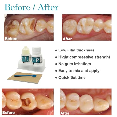 Longkason Zinc Oxide Eugenol Dental Cement Kit | Super Adhesive | Instant Tooth Repair, Cap, Crown & Bridge Filling | DIY, Self Curing, Sturdy & High Strength |Universal Shade| Emergency Dental Care | - Thumbnail 4