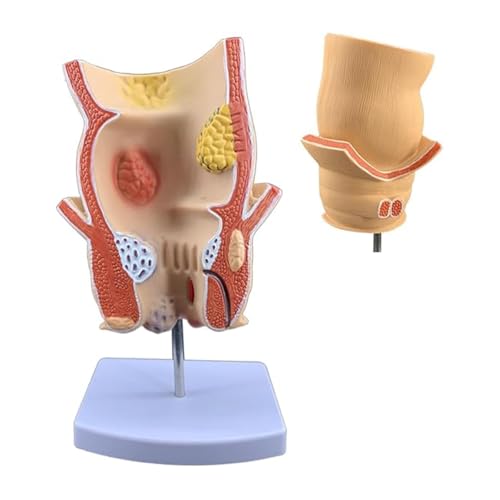 Human Rectal Pathology Model,Rectal Ulcer Anatomical Model,Anorectal Acne Model with Base,for Medical Learning Display and Clinical Education