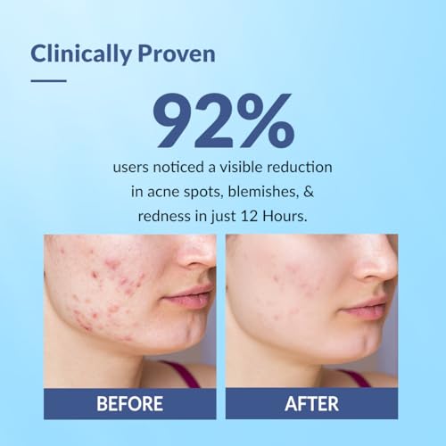 Image of Fixderma Salyzap 2% Salicylic Acid Acne Spot Corrector Gel with 2% Niacinamide Acid & 1% Aczero | Reduce Active Acne & Redness | Fades Dark Spots & Blemishes | Pimple Remover For Men & Women - 20g