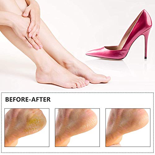 Electric Foot Callus Remover Kit, ELMCHEE Rechargeable Pedicure Tools Foot Care Feet File With 3 Roller Heads,2 Speed,Battery Display for Remove Cracked Heels Calluses and Dead Skin(Black) - Thumbnail 6