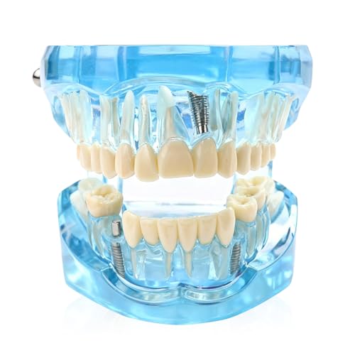 Modelo dental, modelo de dientes de demostración, modelo de dientes de implante de 9 x 7 x 6 cm con dientes extraíbles, modelo de dientes para enseñanza, modelo de dientes enfermos para enseñanza