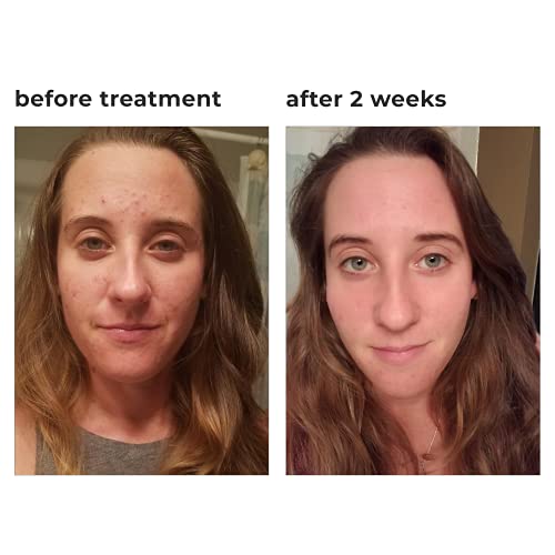 5 Step Acne Treatment Kit, Complete Acne Treatment System for Blackheads, Whiteheads, Cystic, & Hormonal Acne, Powerful Natural Ingredients, Complete Acne Skincare Routine, by TreeActiv - Thumbnail 2