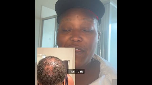 Amazon.com: Capillus Pro 行動雷射治療帽：適用於頭髮再生，配備272