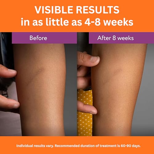 Abera Scar Cream - Advanced Nano Formula for New and Old Scars - Effective for Keloids, Stretch Marks, Surgical Scars, and Acne Marks - Restores Smooth-Looking Skin (1 Box) — view 3