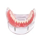 Dental Teaching Tooth Model Overdenture Inferior with 2 Implants Demo Tool #6002