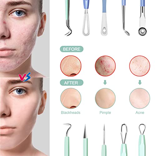 Pimple Popper Tool Kit, Menoly 10Pcs Blackhead Remover Tools, Pimple Extractor,Acne Tools, Acne Kit For Blackhead,Blemish,Zit Removing, Whitehead Popping And Comedone Extractor Tool With Leather Bag #TOP4