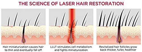 iRestore Essential Laser Hair Growth System + Rechargeable Battery Pack - FDA Cleared Hair Growth for Men & Hair Loss Treatments for Women with Thinning Hair, Hair Regrowth for Women