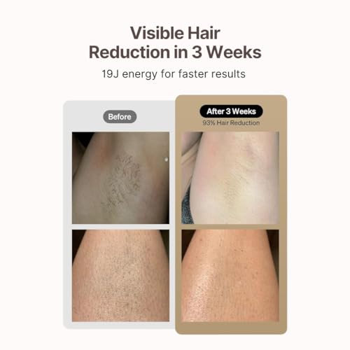 Image of IPL Hair Removal Laser Machine Ice Cooling, FDA-Approved Salon-Like Permanent Hair Reduction with 0C Cooling for Whole Body, Bikini, Face (Women & Men) (Black)