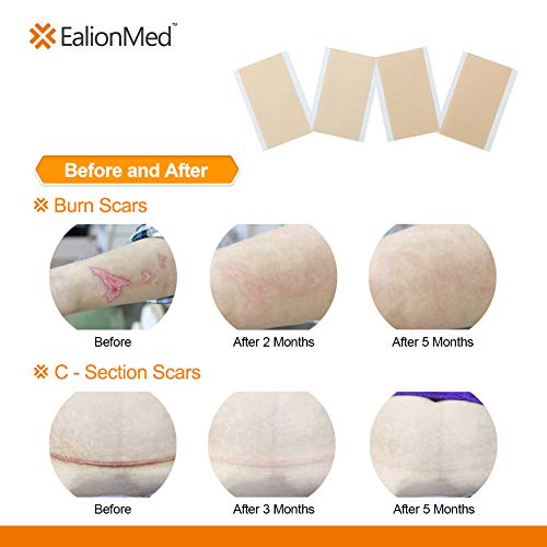 Buy Silicone Scar Sheet, Scar Away, Scar Removal Treatment Sheet, 5.9