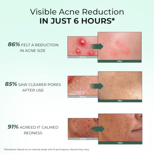 Image of Conscious Chemist Rapid Relief Acne Spot Corrector Gel | 15g | Triple-Action Treatment with 2% Salicylic Acid & Azelaic Acid | Clears Pimples, Reduces Redness & Fades Dark Spots | For Men & Women