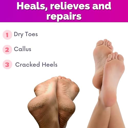 Foot Cream, Cracked Heel Repair, Foot Cream For Dry Cracked Heels And Feet, Dry Feet, Foot Care Cream With Urea And Lactic Acid. Cracked Heel Tcream, Improve The Appearance Of Your Heels #TOP1