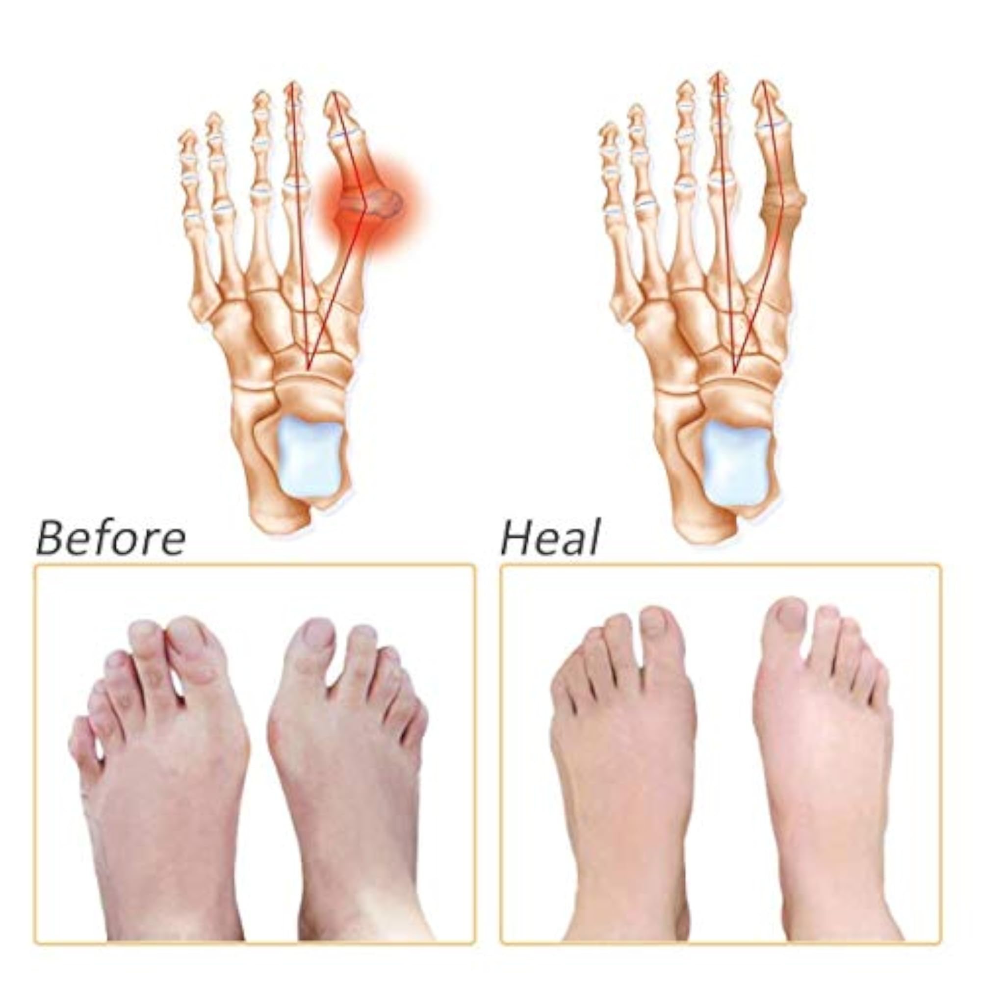 Silicone Gel Half Toe Sleeve for Pain Relief