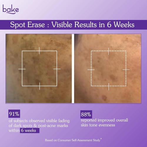 BAKE Spot Erase Dark Spot Correcting Serum Cream | 5% Azelaic Acid, 3% Kojic Acid Dipalmitate & 1.5% Alpha Arbutin | Helps Reduce Dark Spots & Pigmentation | All Skin Types | (1.01 fl oz) - Image 5