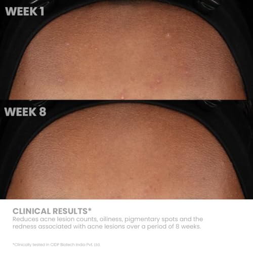 Image of Acnestar Gel | For Acne prone skin- 22gmx2