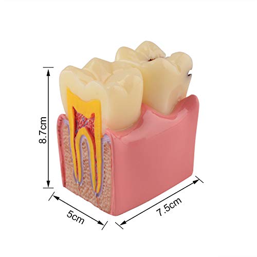Ultrassist Dental Tooth Decay Model 6 Times Dental Caries Teeth Model Caries Bilateral Comparison Pathology Model Teeth For Dental Education Supplies, Tooth Pathology Display #TOP6
