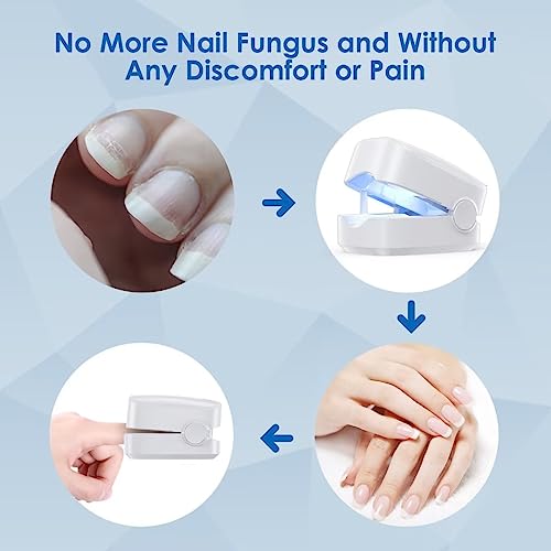 Zzp Nail Fungus Cleaning Laser Device Nails And Fingernails In 7 Minutes A Day Effectively Cleaning And Fully Disinfecting #TOP5