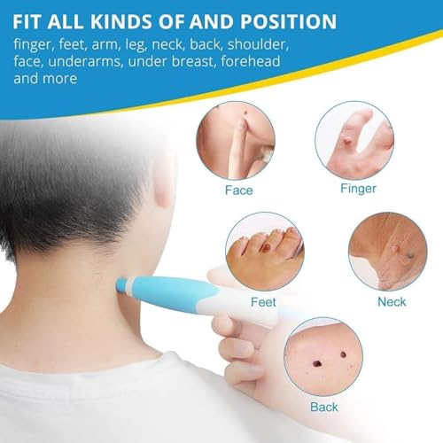 Image of Upgraded 2-in-1 Skin Tag Removal Kit - Auto Skin Tag Remover for Micro to Large Tags (2mm-8mm) - Includes Micro & Regular Removal Bands - Safe & Effective Skin Tag Remover Tool