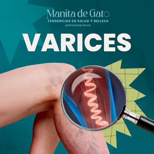 『Várices y trombosis: cómo prevenir y cuidar la salud de tus piernas』のカバーアート