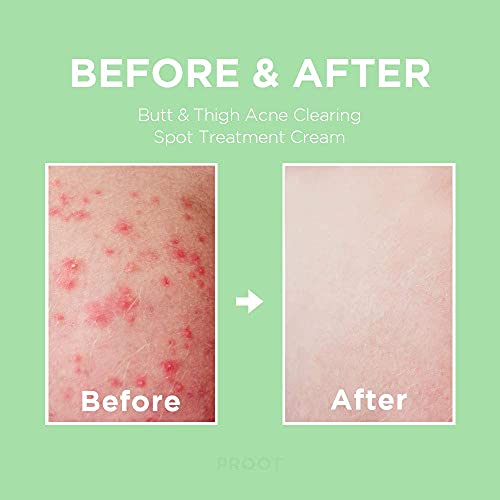 Proot Butt Acne Spot Treatment Cream (Tube Type) + Back & Body Acne Spray Bundle | Treatment Cream And Body Spray For Acne, Cellulite, Ingrown Hair, Bikini & Razor Bump | For All Skin Type #TOP1