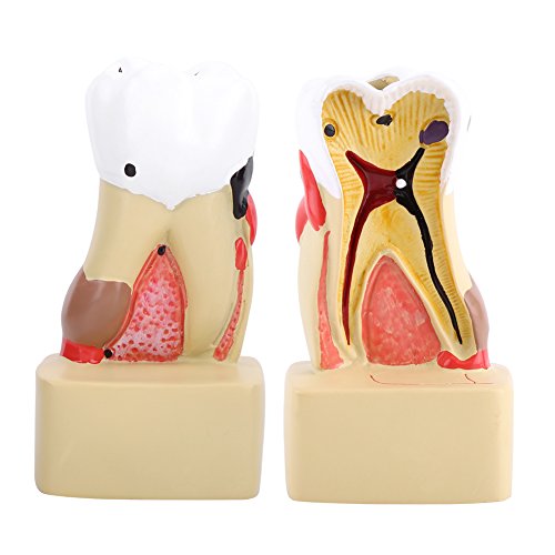 Mondelinge cariës Model Tandziekte Tand Model Tand Profiel Model Cross-Section Uitgebreid met Zenuw voor Tandarts Studie… - Image 6