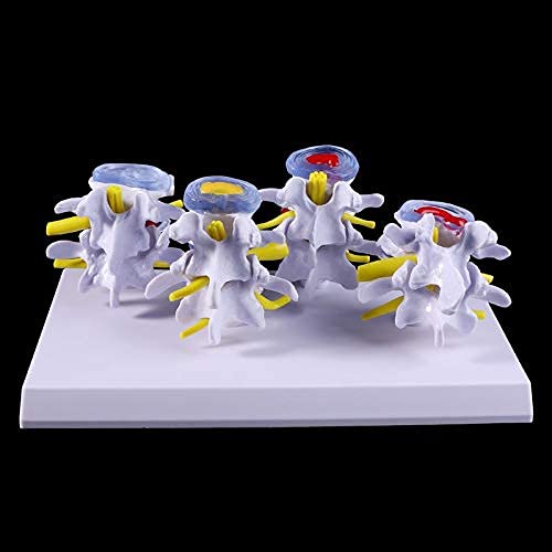 QIQIZHANG Anatomy Model, Human Lumbar Lesion Spine Statue Display Model Medical Teaching Learning Tool for Medical Demonstration