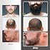 Naland Beard Growth Kit - Beard Kit for Men with Beard Growth Oil (2oz), Beard Balm, Beard Comb, Massager for Spot/Patchy Beard - Christmas, Anniversary, Birthday for Men, Dad, Husband, Boyfriend