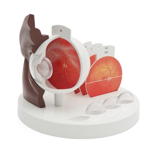 3B Scientific Pathologisches Augenmodell, dunkle Hautfarbe - 3B Smart Anatomy