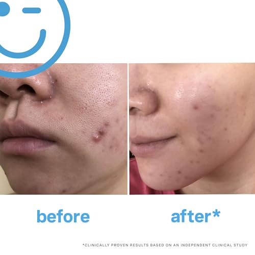 EradiKate 3% Sulfur Daily Foaming Cleanser Acne Treatment – Clinically Formulated Medicated Face Wash Balances Skin and Cleans Pores, 4 Fl Oz - Image 3