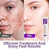 12% Acid Spot Cream - Acne Treatment - Acne Cream for Spot Prone Skin - Anti, Rosacea for Face,Pimple Crea-m,Dark Spo-t Remover - Pimple cream Face Moisturiser - Even Skin Tone - Image 3