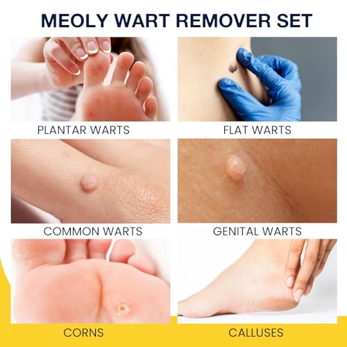 Image of MEOLY Plantar Wart Remover Set: Maximum Strength Salicylic Acid Plantar Wart Remover 12 Thick Cushioning Pads
