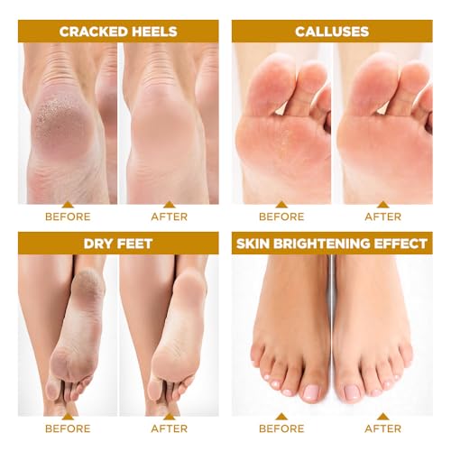 Lavinso Honey Feet Peeling Mask for Dry Cracked Feet - 3 Pack - with Kojic Acid Skin Brightening Effect - Exfoliating Dead Skin and Calluses - Foot Peel Mask for Baby Soft Feet