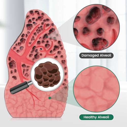 Image of Ultrassist Smoking Lung Model with Tar Damage, Lung Anatomy Model for Smoking Education