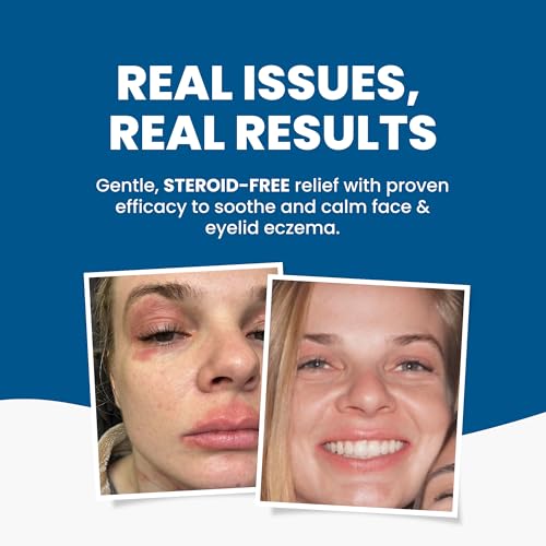 Image of Grahams Natural Face & Eyelid Oil - For Very Dry Skin Around Eye & Face, Eczema & Perioral Dermatitis - Steroid-Free, Hypoallergenic, Non-Comedogenic - 100% Pure - with Argan & Jojoba Oil (1.69 Fl Oz)