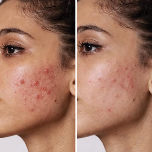 Image of Biomlogy Anti Acne Face Serum 22% Actives with 2% Salicylic Acid, 7% Niacinamide, 2% Ceramide, Prebiotic for Oily & Acne Prone Skin |Controls Excess Oil, Fades Acne Marks, Barrier Care| 10 ML