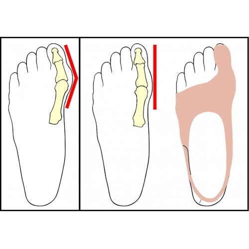 Tageskorrektor Hallux Valgus links (S)