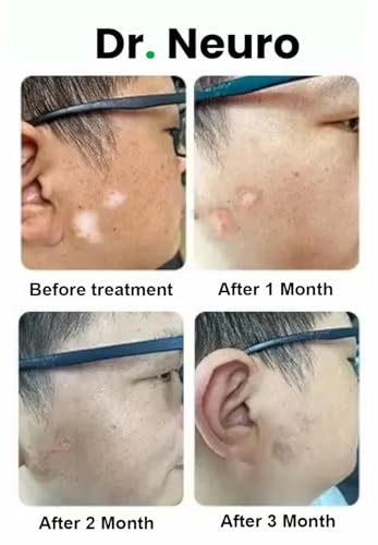 Image of Dr. Neuro NarrowBand UVB Phototherapy Light Device With NBUVB 311nm Lamp | Treatment For Vitiligo, Psoriasis, Eczema, Dandruff | Protection Eye Goggle Included | Blue UV |2 YEARS Warranty By CoverTag
