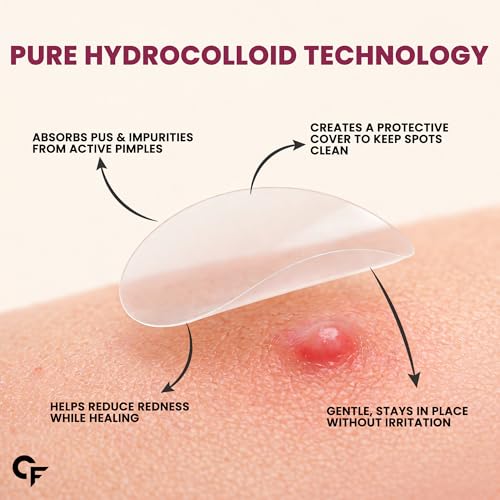 Image of Carbamide Forte Pimple Patches for Face Salicylic Acid & Cica | 72 Hydrocolloid Acne Patch | Invisible Waterproof Pimple Patch Absorbs Pus & Impurities for All Skin Types