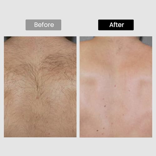 Image of Diode Laser Hair Removal, Hair Removal Device for Skin Tone 1-5, Permanent Reduction in Hair Regrowth, Home-use Wide-Angle 810nm Laser Hair Removal Device