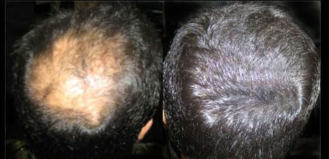 Hair Building Fibers 100% Wool - Natural Keratin. Size: 1/2 a Pound (227Grams) Bulk Refill Pack 60-80% SAVINGS. Thinning Hair/Bald Spots Toppikk, Sure Thick & Bosley. (Medium Brown, 227 grams)