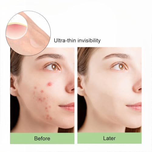 TIKIYOUN Adesivos de espinhas para acne hidrocolóide facial para cobrir espinhas e manchas, 2 tamanh