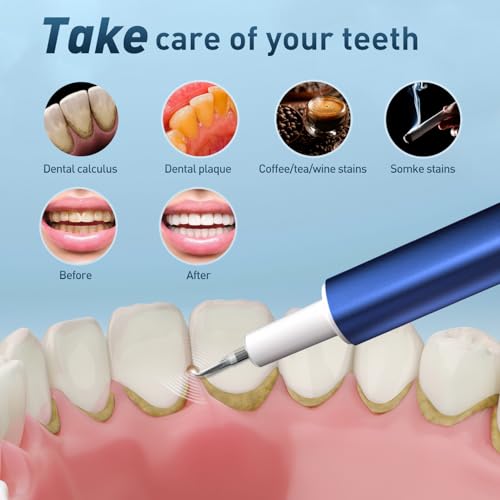 Frenzolite R1 Plaque Remover For Teeth thumb #2
