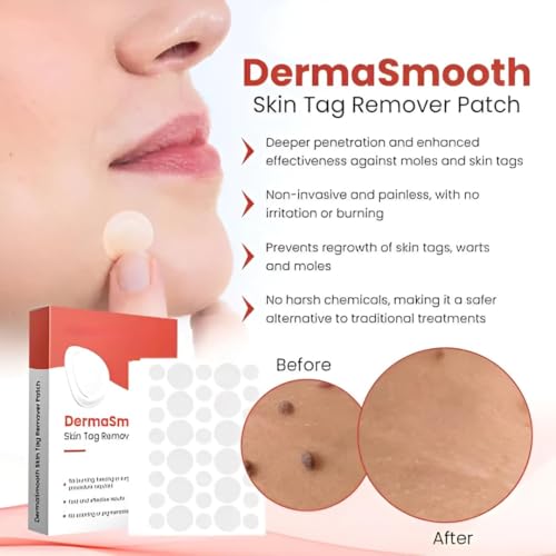 Image of Derma Smooth Skin Tag Removal Patches - 144 Patches | Gentle & Effective Skin Tag Remover for All Skin Types | Easy & Pain-Free Application